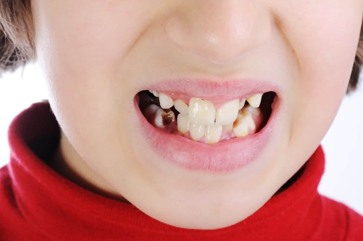Bad child teeth